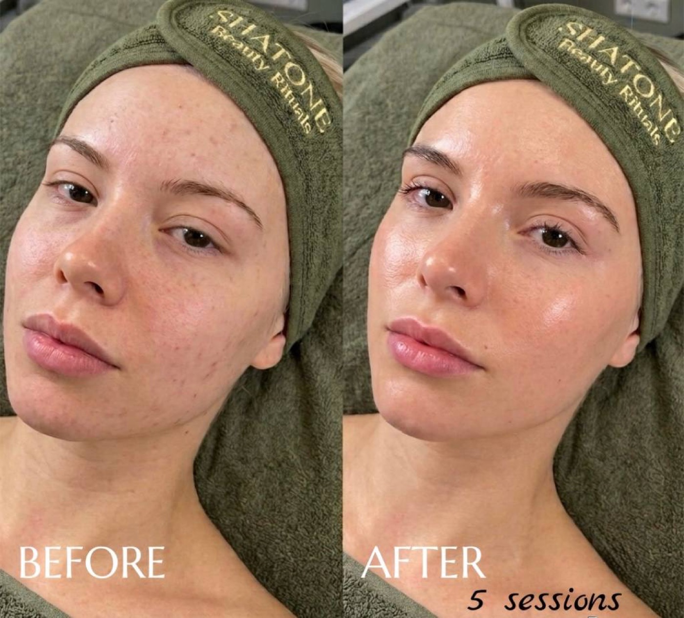 Acne Control — before/after result