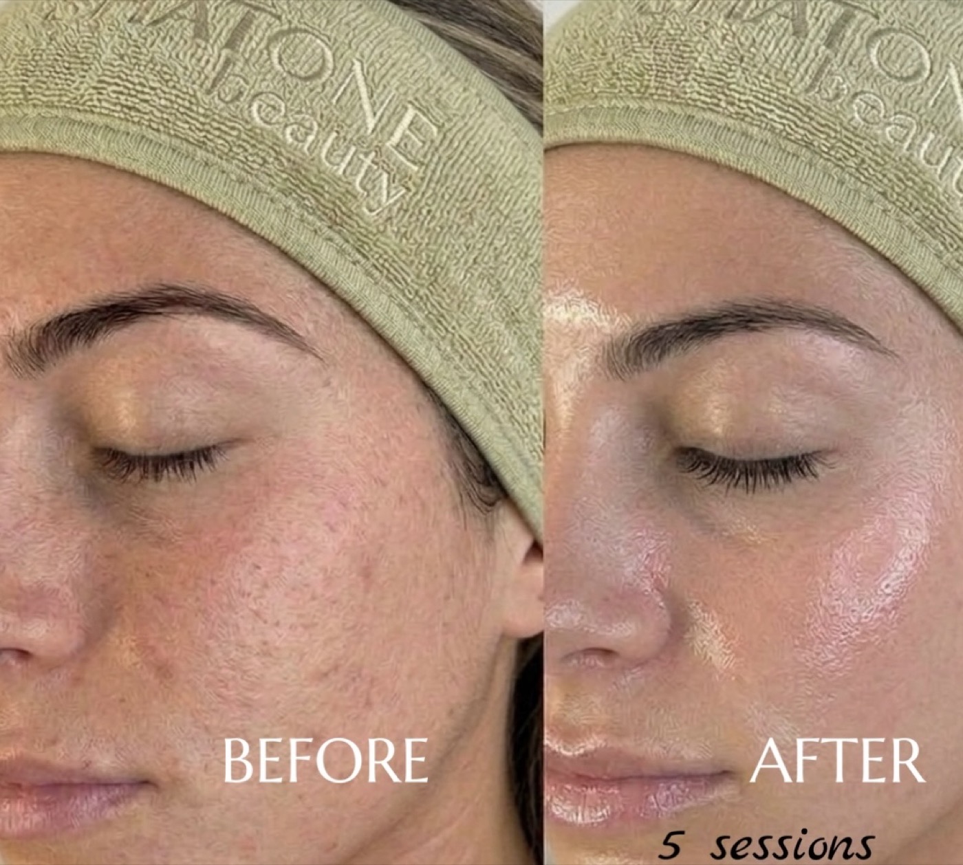 Hydrafacial — before/after result