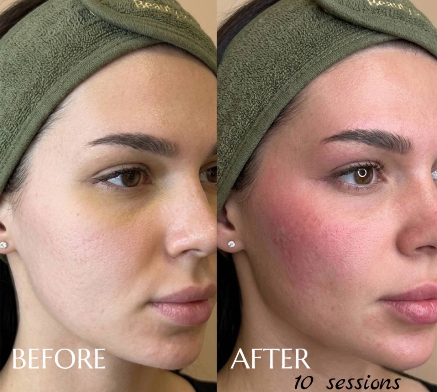 Lift & Sculpt — before/after result